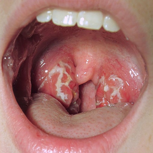 A case of strep throat